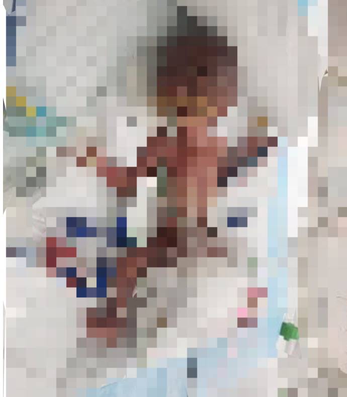 新加坡最輕早産兒僅345克，花了20多萬新幣才救活！新加坡看病到底有多貴