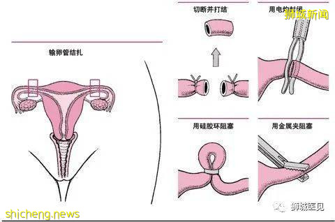 救命!家里的熊孩子不能再多了!新加坡这些避孕方法赶紧收好