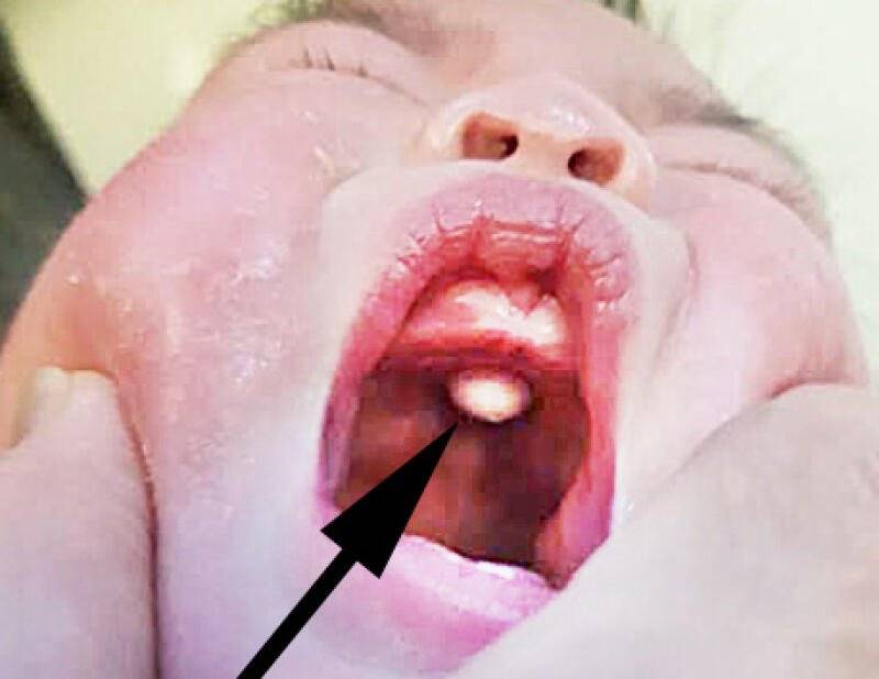 婴儿嘴里卡塑料块 医生竟查不出?