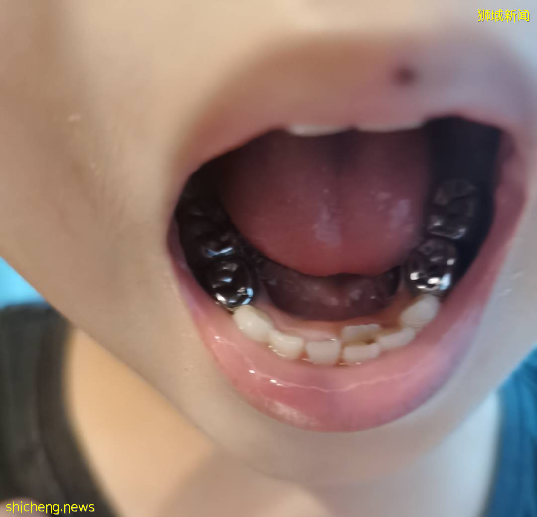 5歲女童拔牙後腦死亡!你還敢隨便在新加坡給孩子拔牙嗎