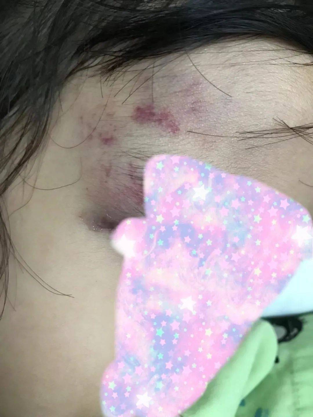 求助:2岁女儿眼睛在新加坡游乐场受重伤!1万多新治疗费!工作人员拒不负责!怎么办