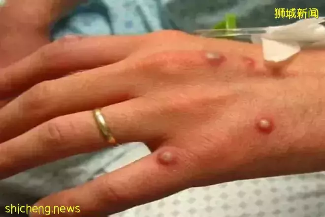 猴痘是如何传播的?新加坡将采取何种应对措施