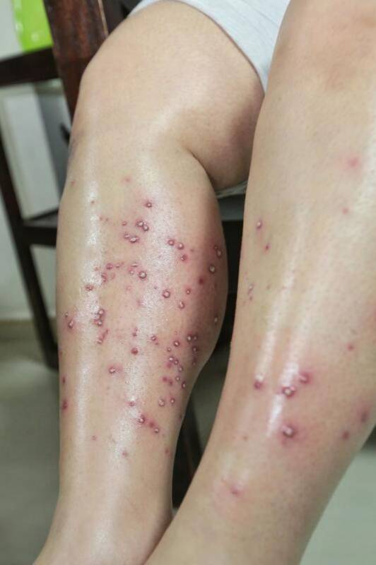 熱蠟脫毛致皮膚感染 婦女花錢買難受