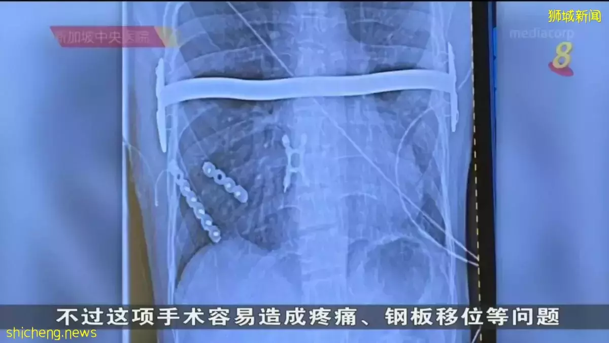 中央医院首次用3D打印技术 成功医治胸部畸形个案