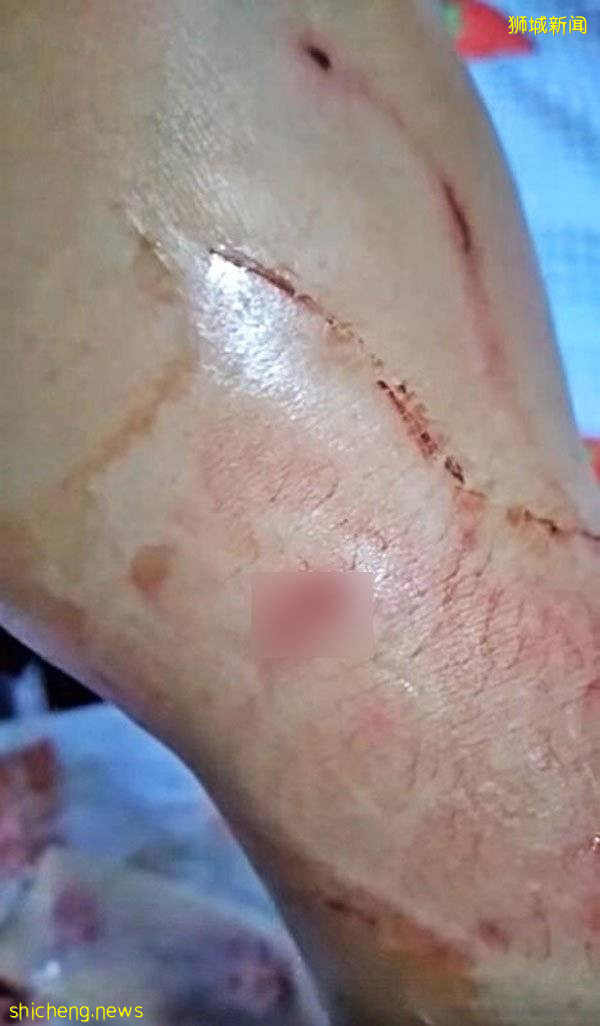 女佣被狗咬伤直流血 雇主只给她一块胶布