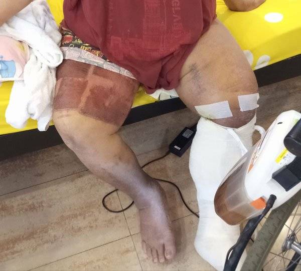 赤脚卖螃蟹 踩到玻璃 伤口感染 台主走了