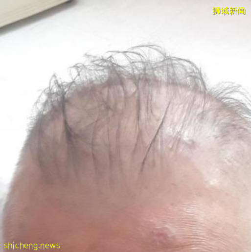新加坡男子接种疫苗后脱发!还好最终长回来了