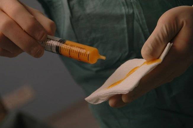 女主管抽脂死亡 医生判赔1680万 