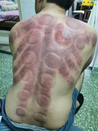 厨师拔罐解酸痛   背部灼伤起水泡  痛到只能趴着睡觉