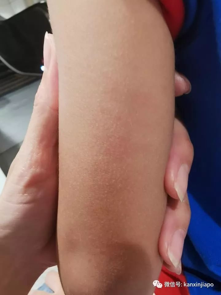 儿子身上多处瘀伤,母亲控诉新加坡幼儿园老师虐童!