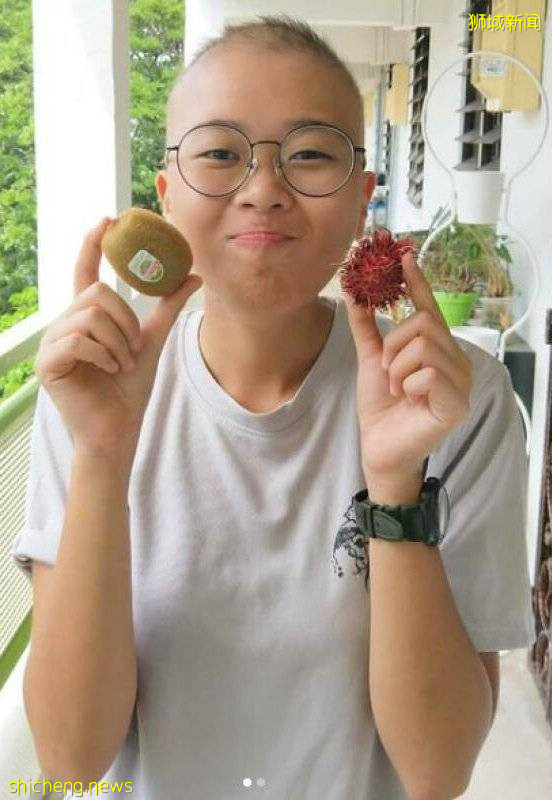 19岁女患斑秃症 毛发近掉光