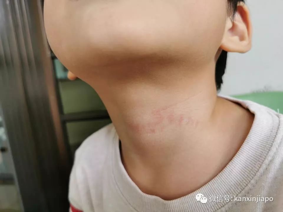 儿子身上多处瘀伤,母亲控诉新加坡幼儿园老师虐童!