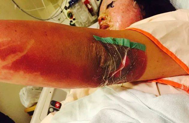 6年前,她在新加坡的中餐馆被毁容!最终获赔10万新币