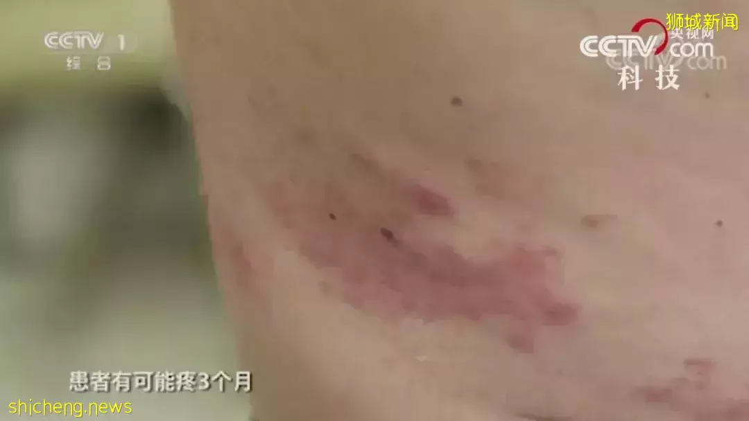 新加坡再發現一種後遺症！口齒不清、閉眼困難！3天後，一波新政出爐備戰"第5波"