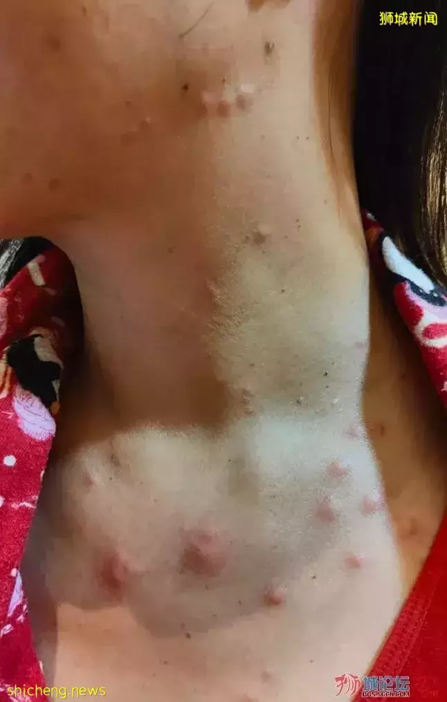 客人在新加坡住酒店遭臭虫咬伤苦不堪言,僵持过后酒店同意全额退款