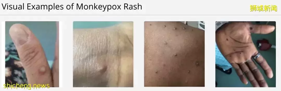 新加坡发现首起本土猴痘病例，源头成谜！患者实拍自述感受！这次会学中国吗