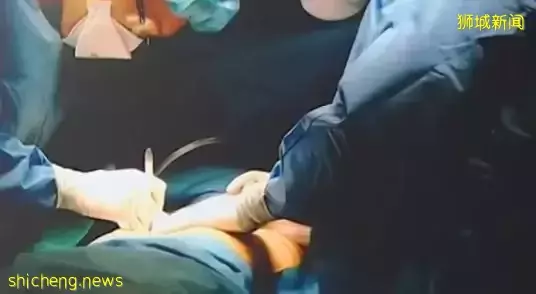 狮城医院3D打印胸腔　医治胸部畸形男子 