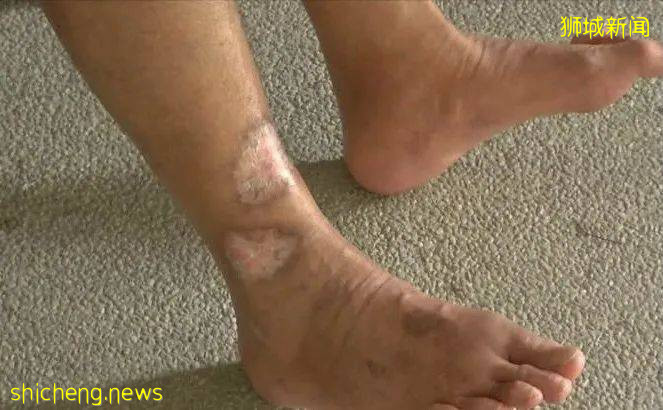 风湿病肆虐新加坡，我们该如何预防