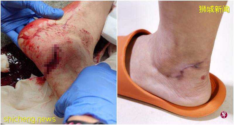 被撞3个月脚踝留疤走路隐隐痛  狮城女会计控诉送餐员未作赔偿