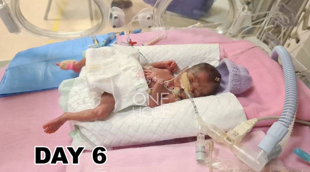 新加坡看病太贵:她的早产儿账单40万新币!女佣病危雇主要花15万新币