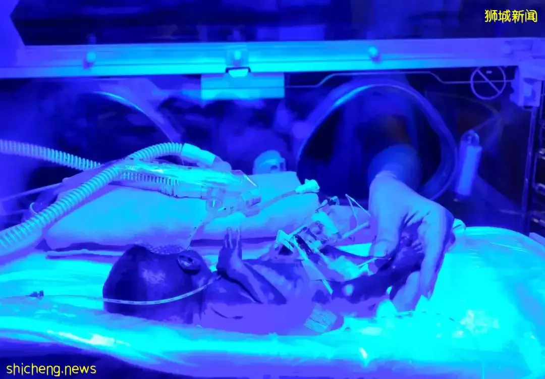 她，懷孕25周就生下孩子！寶寶出生後，在醫院躺了一年多