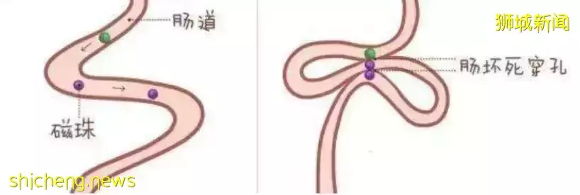 新加坡9歲娃因它切除兩節小腸！這些危險玩具你家可能也有