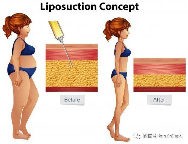 为了减肥去做抽脂手术而死,医生赔560万