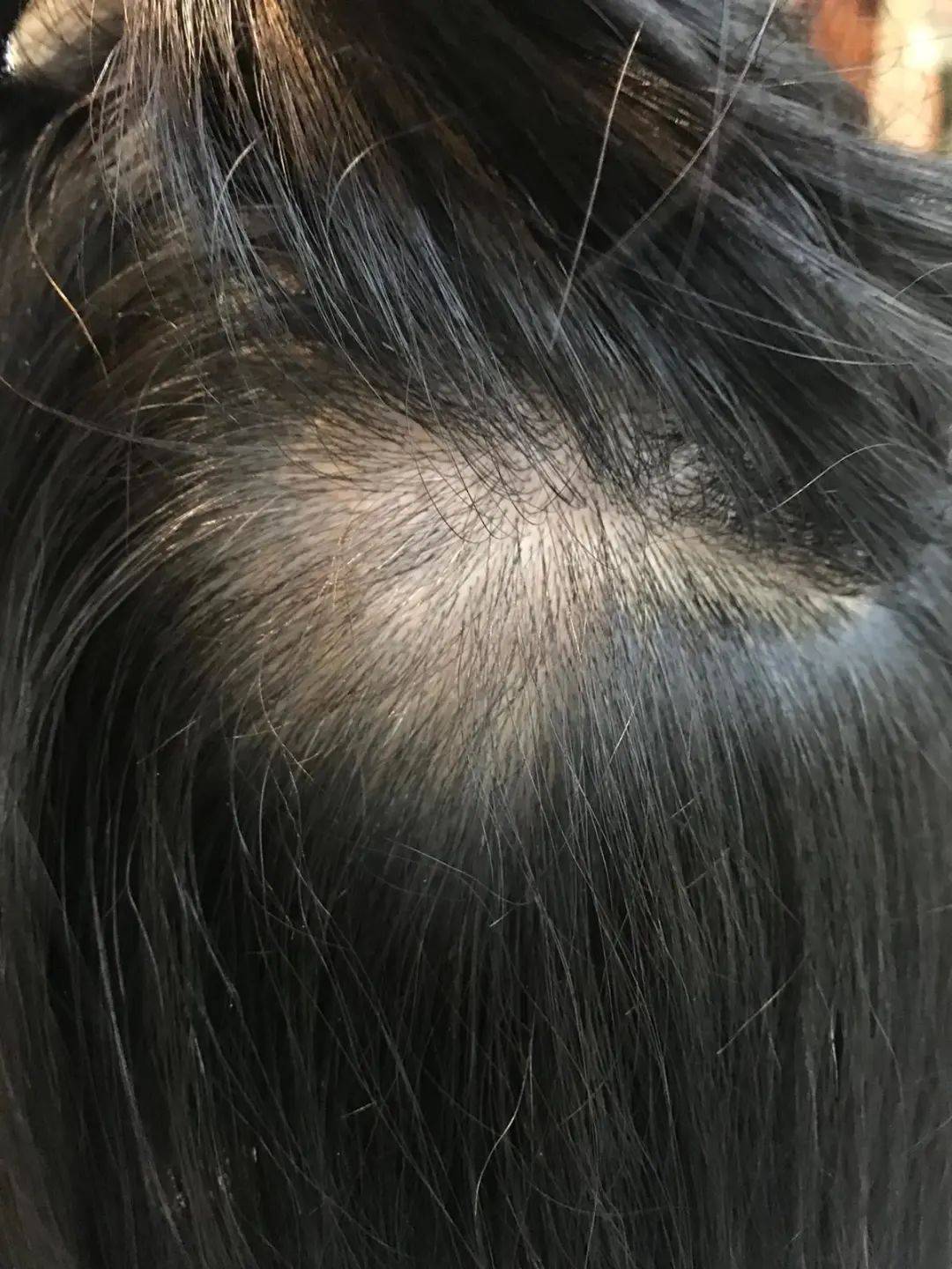 獅城這些“禿”如其來的煩惱,讓它幫你解決