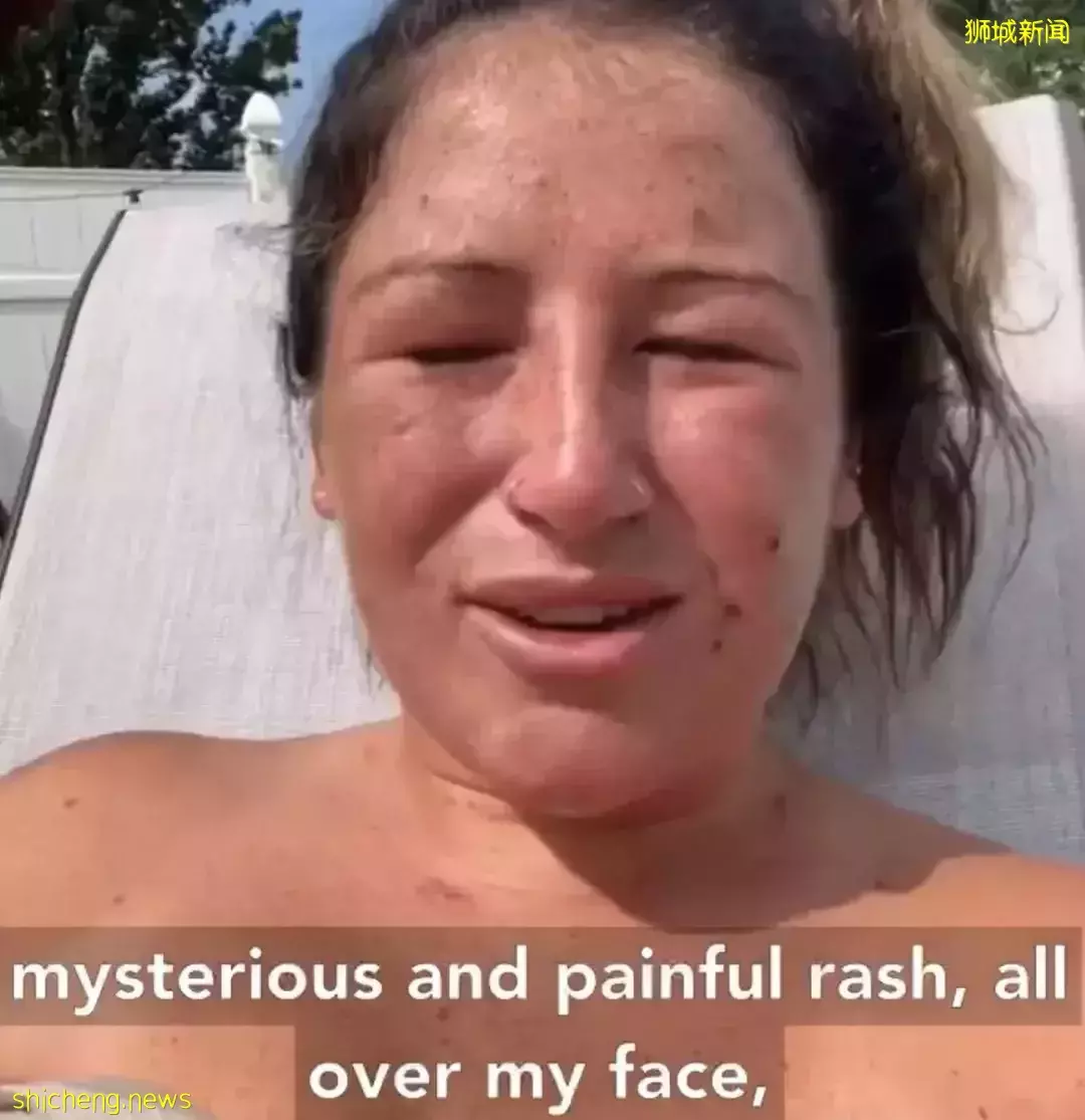 新加坡发现首起本土猴痘病例，源头成谜！患者实拍自述感受！这次会学中国吗