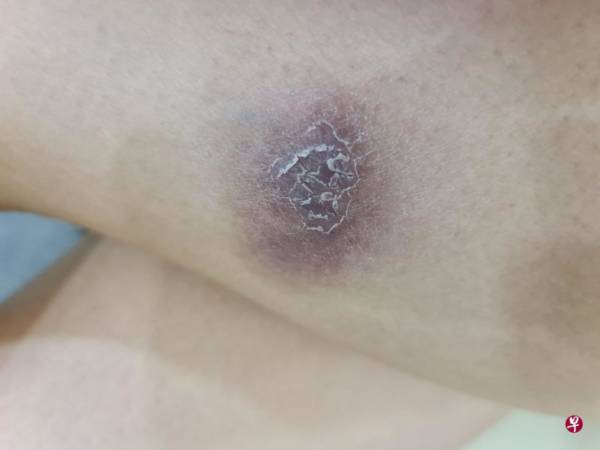 大腿突瘀青再变疼痛 童缤毓明动手术切除肿块