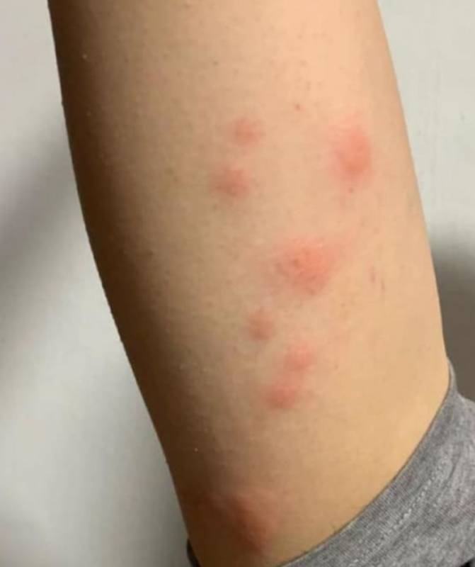 网民吐槽在嘉华影院被看电影被臭虫叮咬