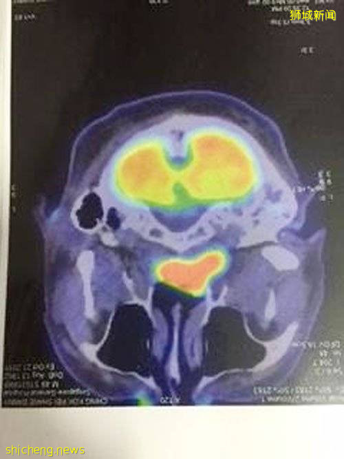 鼻癌第三期奇迹康复 男子出书鼓励癌患