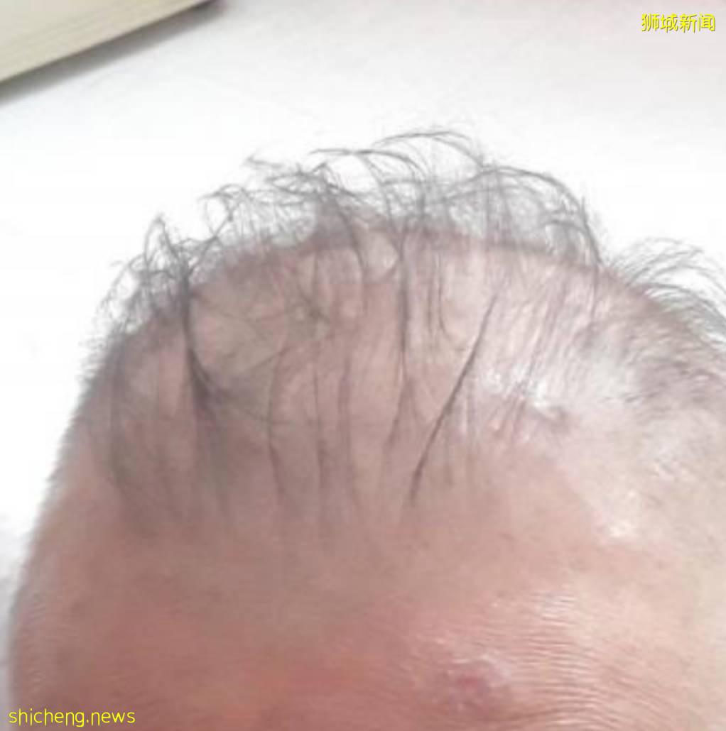 新加坡有人打完2針疫苗後,狂掉頭發!禿了