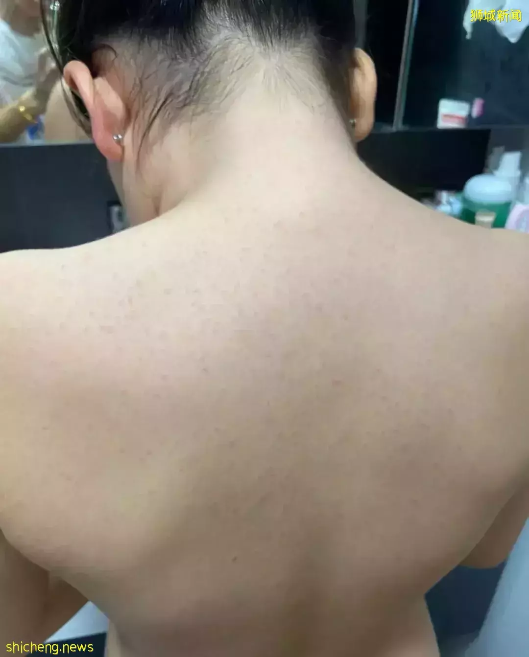 緊急求助！“娃全身紅疹，被新加坡醫生要求全麻開刀！我該怎麽辦？”