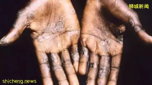 猴痘肆虐！无针对治疗方法！新加坡将保持高度警惕