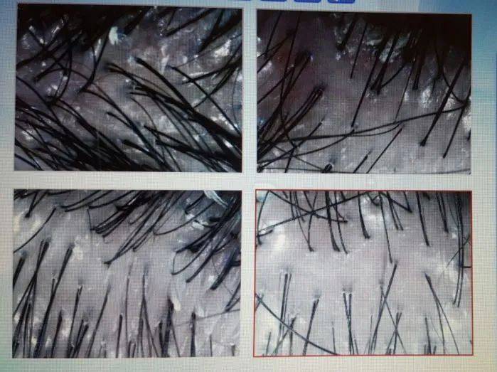 獅城這些“禿”如其來的煩惱,讓它幫你解決