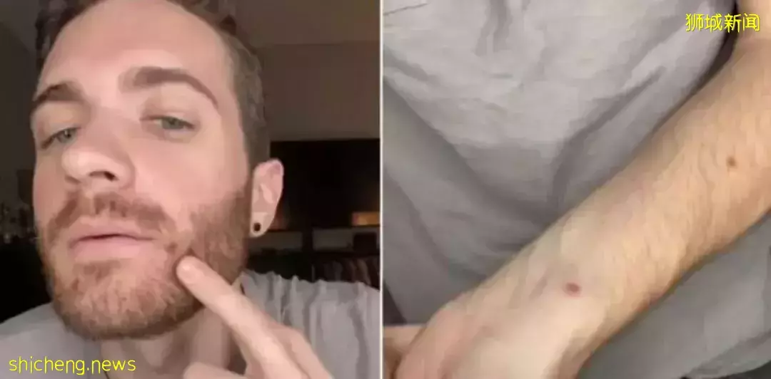 新加坡发现首起本土猴痘病例，源头成谜！患者实拍自述感受！这次会学中国吗