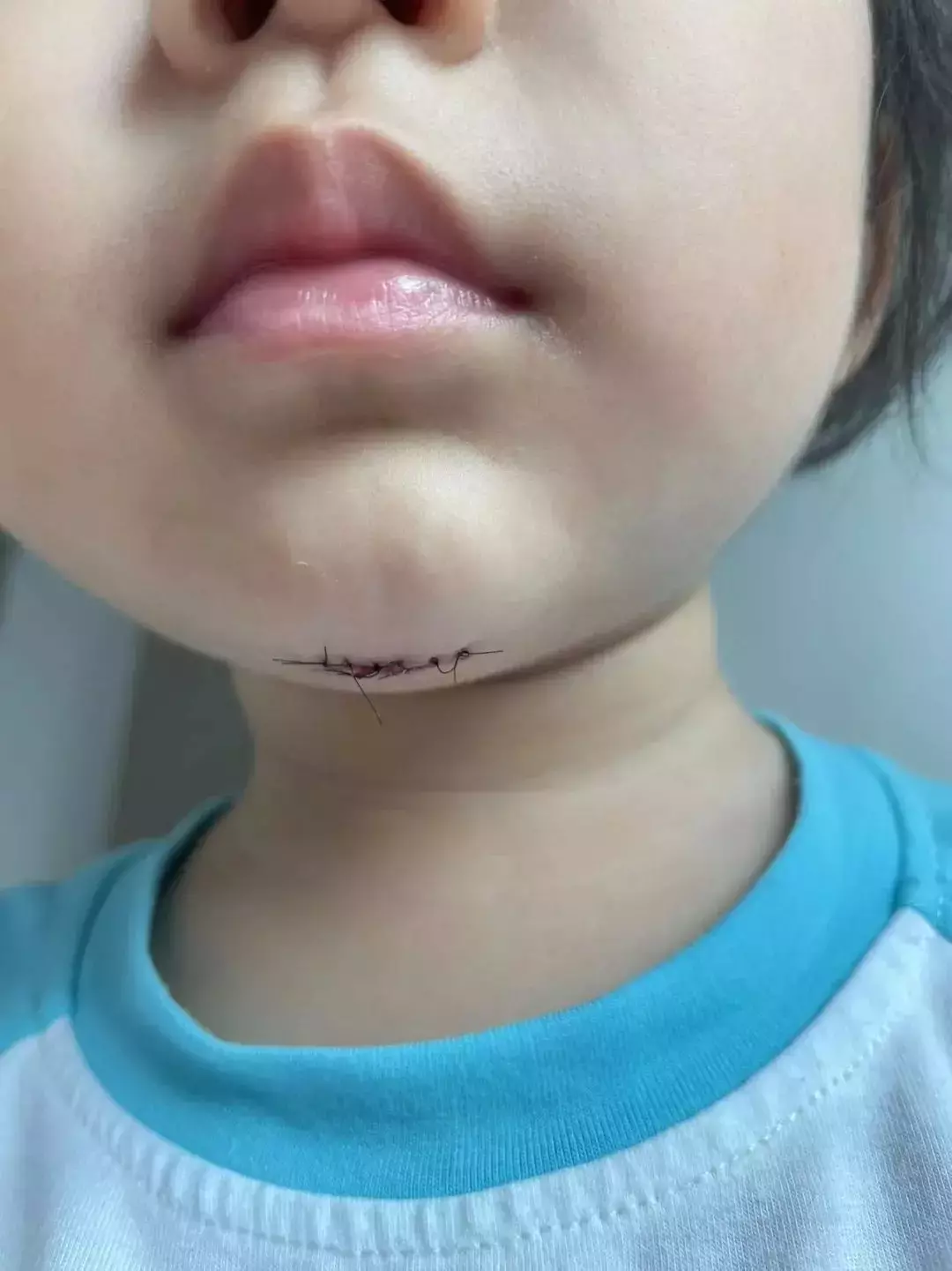 揪心！“1岁多女儿在新加坡幼儿园受伤缝6针，学校的态度令人心寒……”