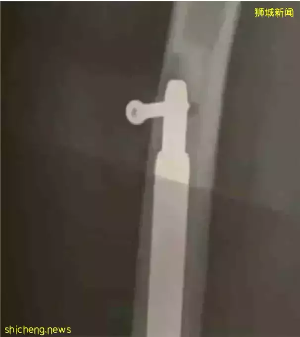 中国妹纸迷恋“增高术”冒疫情飞新加坡手术，结果成了长短腿、差点截肢