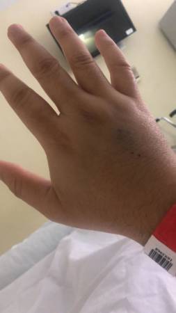 ◤肺炎疫情◢确诊一度肾衰竭 全身肿 陈嘉庚曾孙飙至114公斤