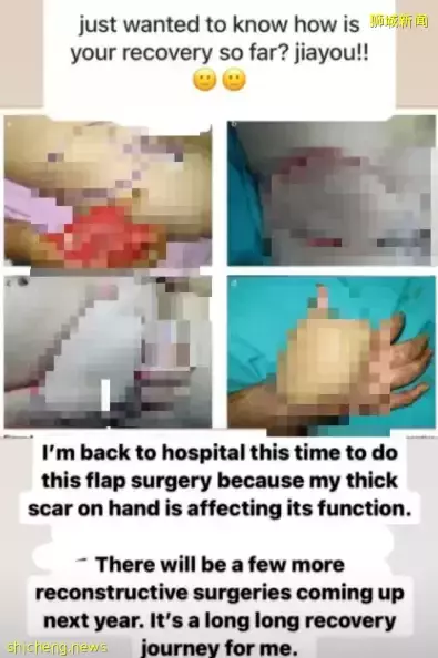 烧伤女歌手胡秀惠为这个客工饯行，因病相识、互相鼓励、重生