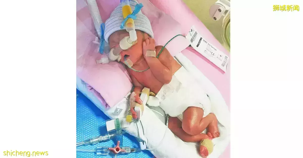 教师诞下早产儿 仅1公斤 器官未完全发育