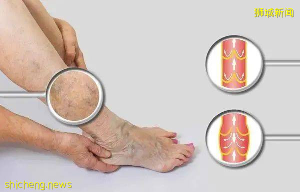 變異病毒“德爾塔”肆虐，社區400多例！徐若瑄在新加坡接種這款疫苗