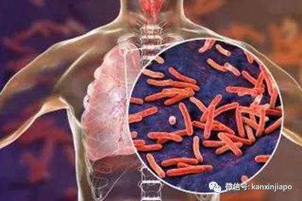 新加坡投注中心18人确诊肺结核,卫生部将进行排查检测