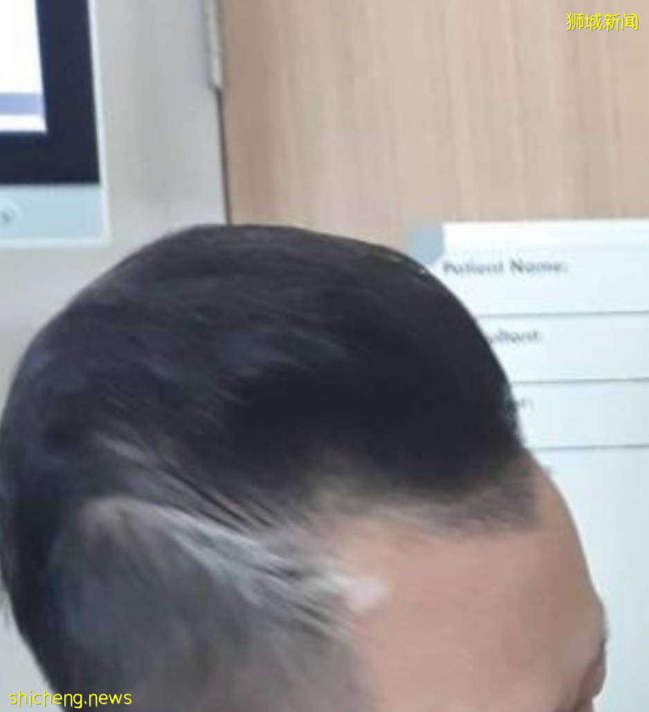 新加坡有人打完2針疫苗後,狂掉頭發!禿了