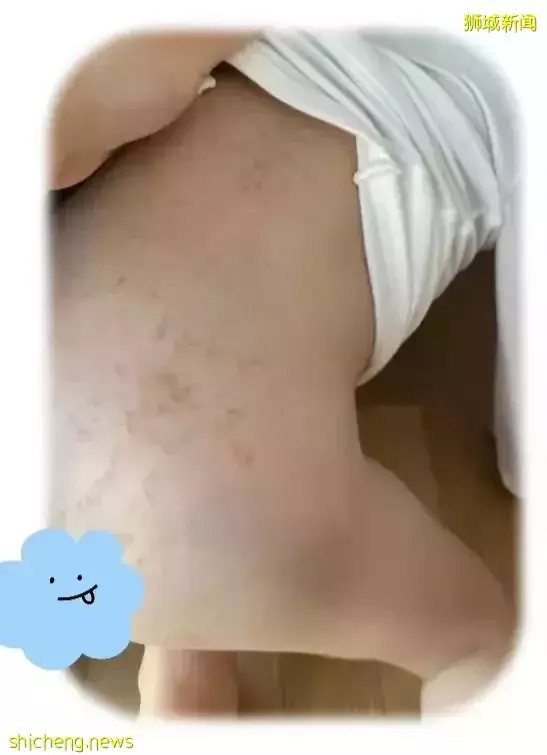 新冠疫情副作用顯現:據說去年這種疫病的患者上升了20%