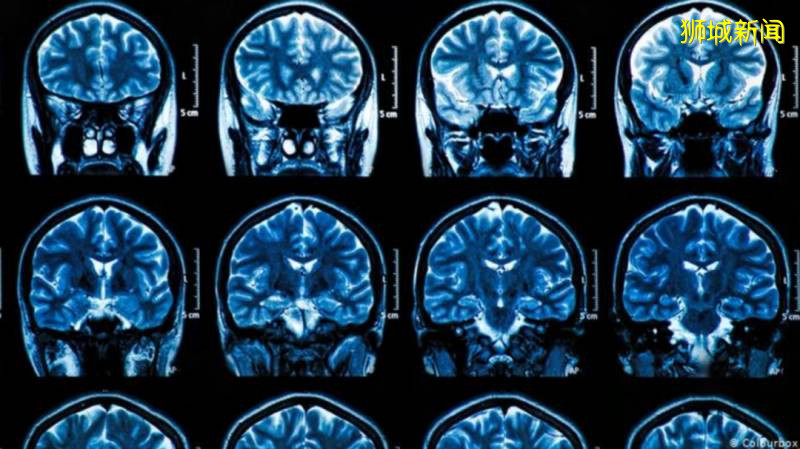 新加坡今增322例！研究发现：新冠轻症者也可能大脑严重受损