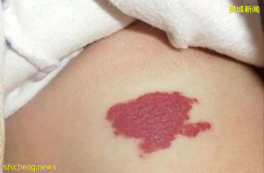 5歲女童拔牙後腦死亡!你還敢隨便在新加坡給孩子拔牙嗎