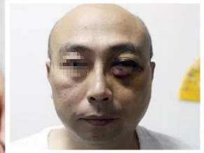 怀疑丈夫养小三，新加坡外籍妻子打的丈夫左眼失明大呼：家暴！离婚