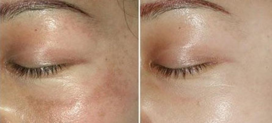 冻龄女明星偷偷都在做的那些热门「医美项目」!!你不想试试吗?